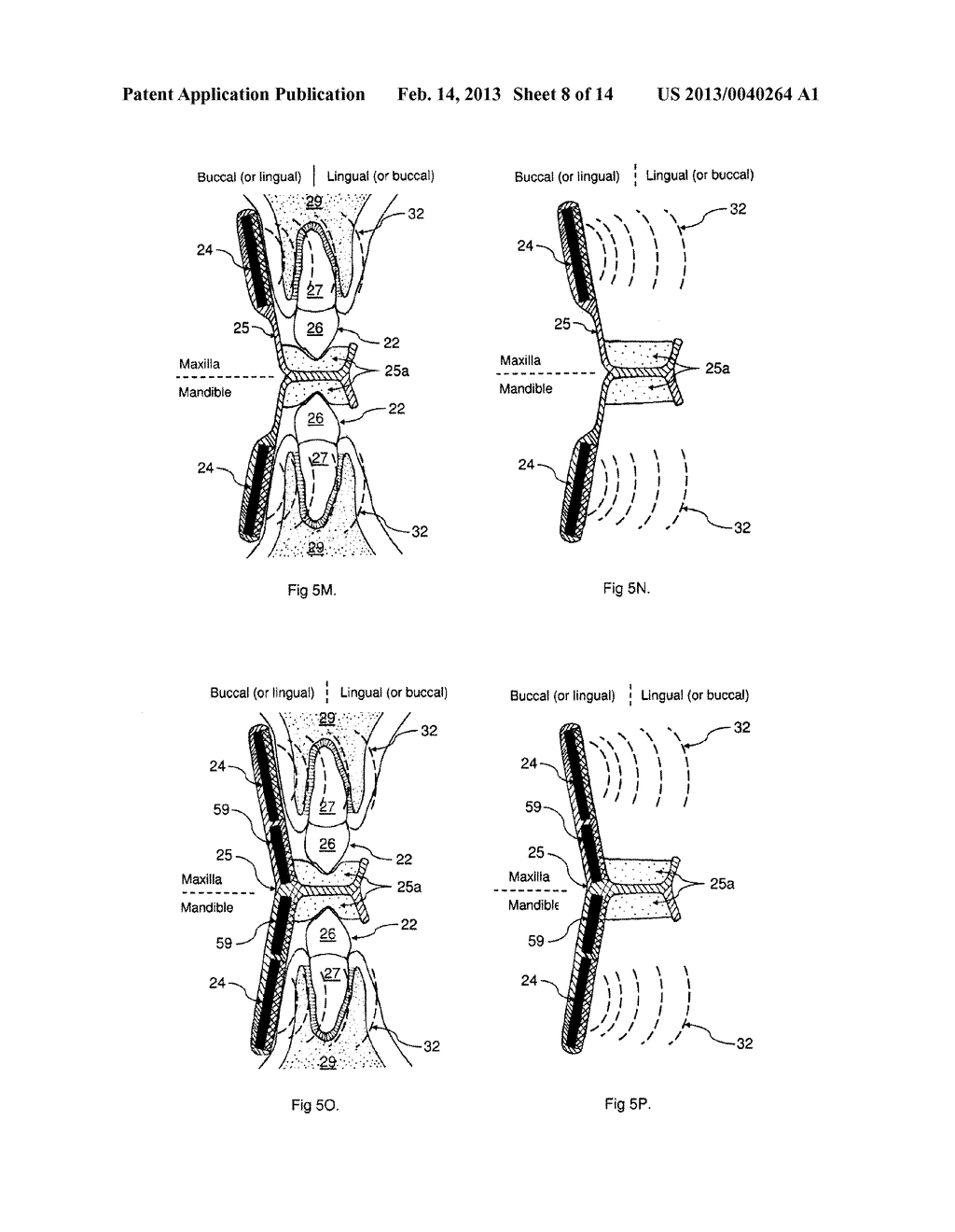 ULTRASONIC METHOD AND DEVICES FOR DENTAL TREATMENT - diagram, schematic, and image 09