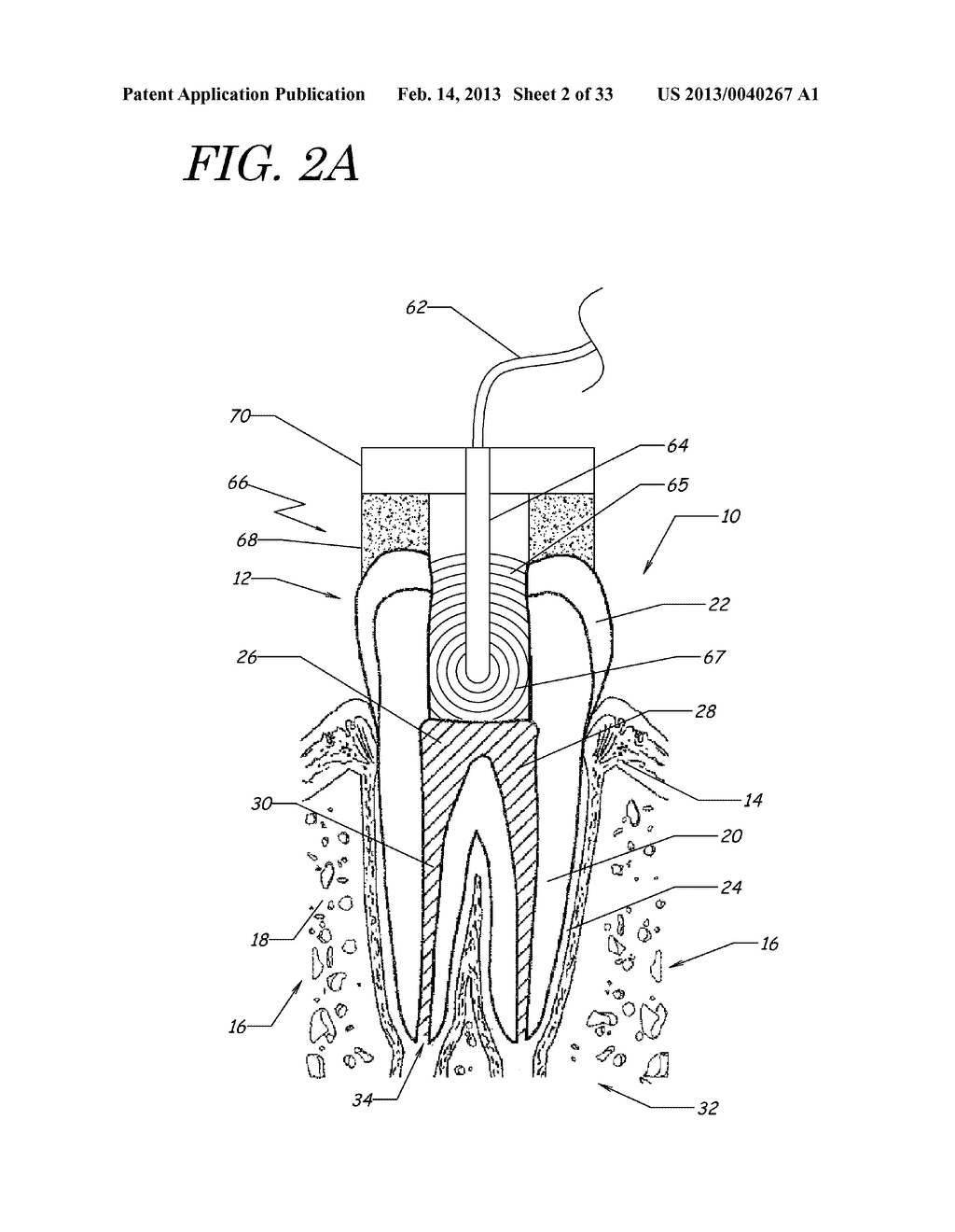 APPARATUS, METHODS, AND COMPOSITIONS FOR ENDODONTIC TREATMENTS - diagram, schematic, and image 03