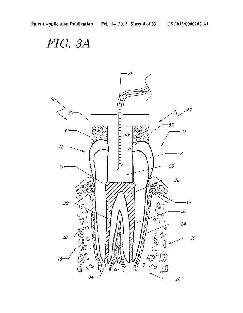 APPARATUS, METHODS, AND COMPOSITIONS FOR ENDODONTIC TREATMENTS - diagram, schematic, and image 05