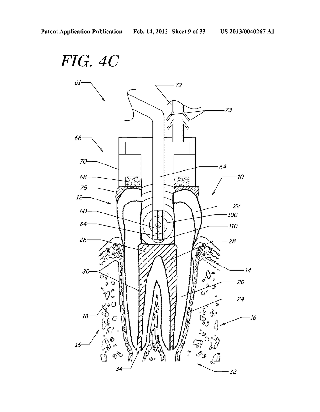 APPARATUS, METHODS, AND COMPOSITIONS FOR ENDODONTIC TREATMENTS - diagram, schematic, and image 10
