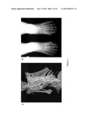 SIRNA-BASED THERAPY OF FIBRODYPLASIA OSSIFICANS PROGRESSIVA (FOP) diagram and image