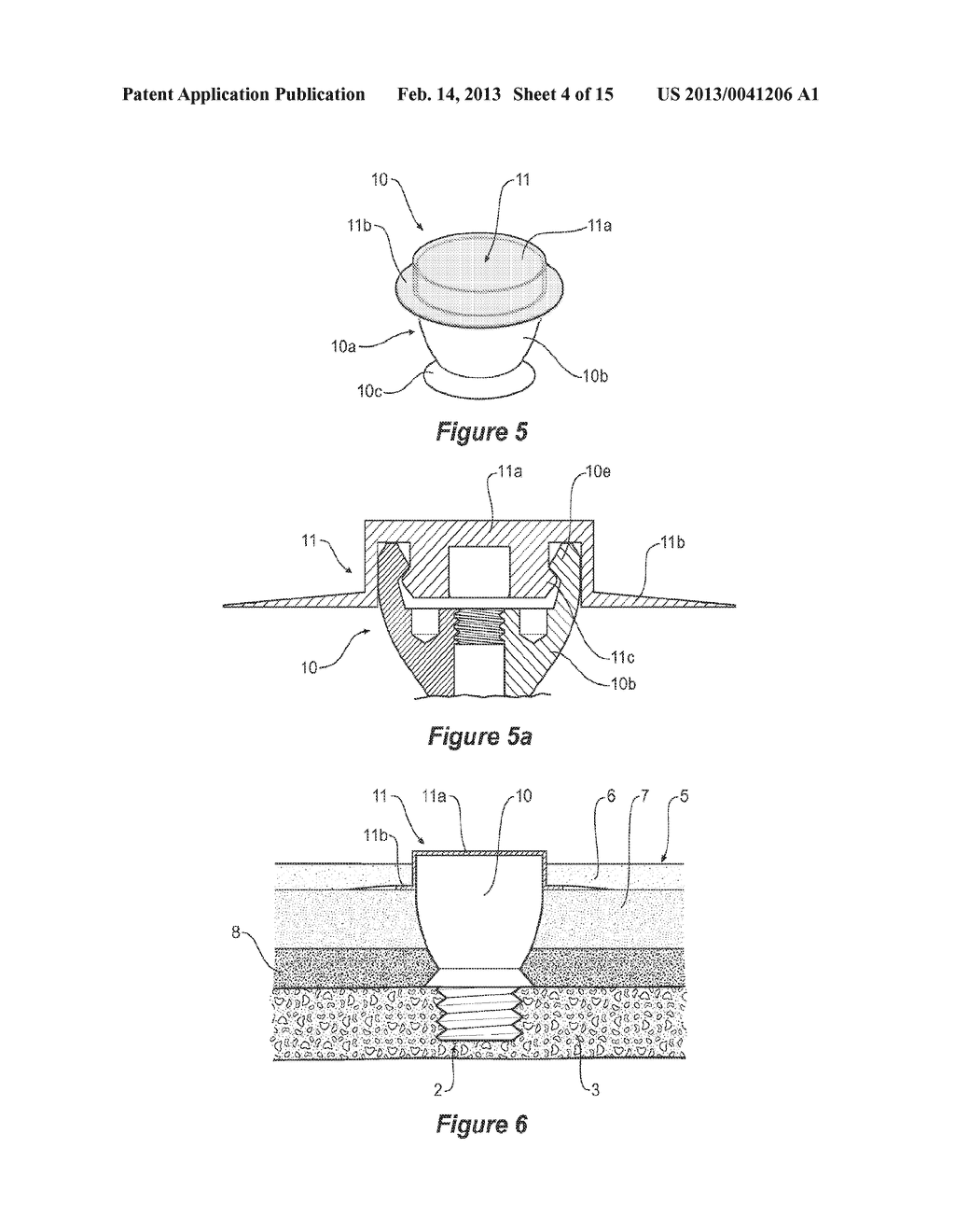 EPIDERMAL DOWN-GROWTH BARRIER - diagram, schematic, and image 05