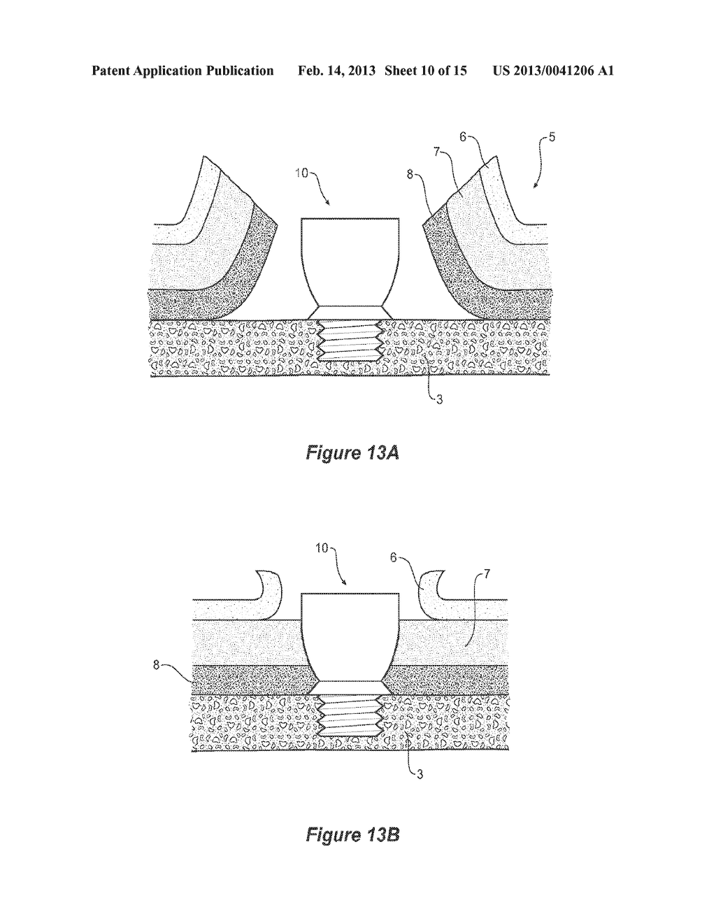 EPIDERMAL DOWN-GROWTH BARRIER - diagram, schematic, and image 11