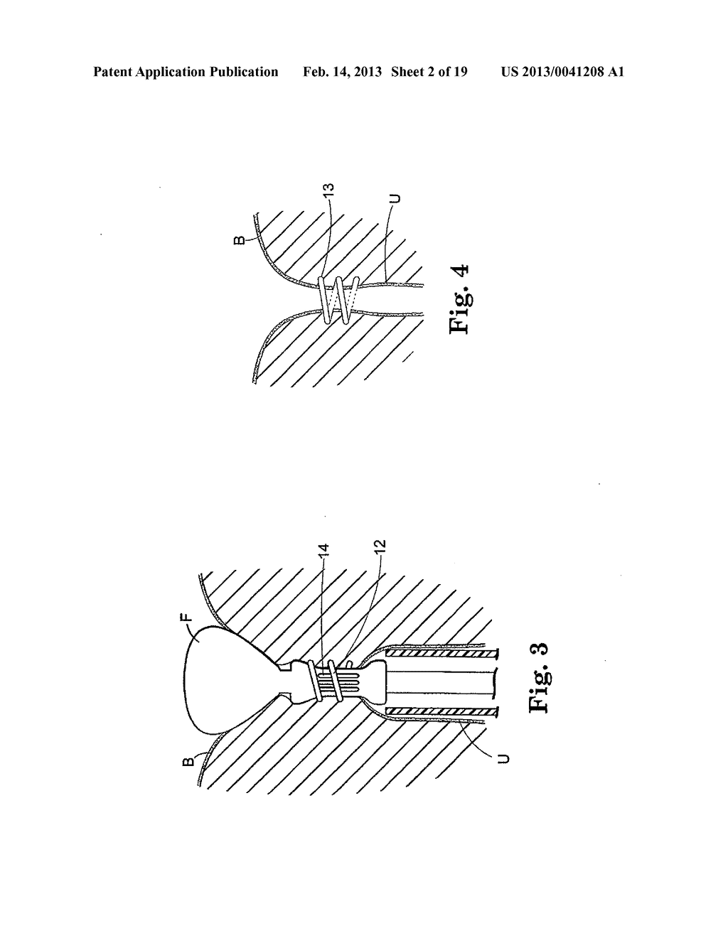 SURGICAL ARTICLES FOR PLACING AN IMPLANT ABOUT A TUBULAR TISSUE STRUCTURE     AND METHODS - diagram, schematic, and image 03