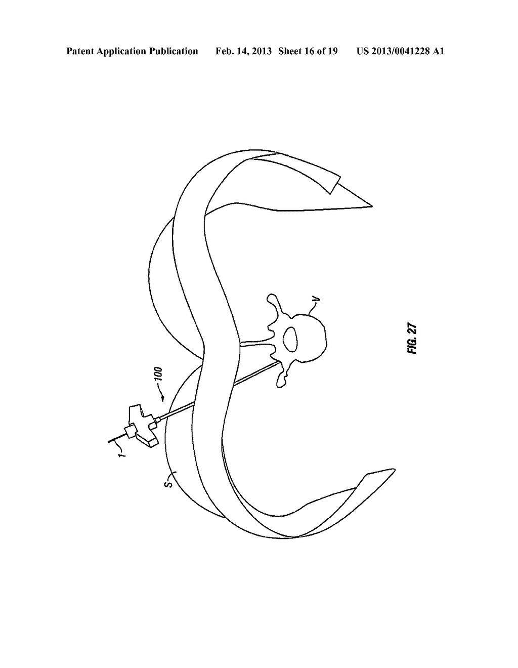 MINIMALLY INVASIVE RETRACTOR AND METHODS OF USE - diagram, schematic, and image 17