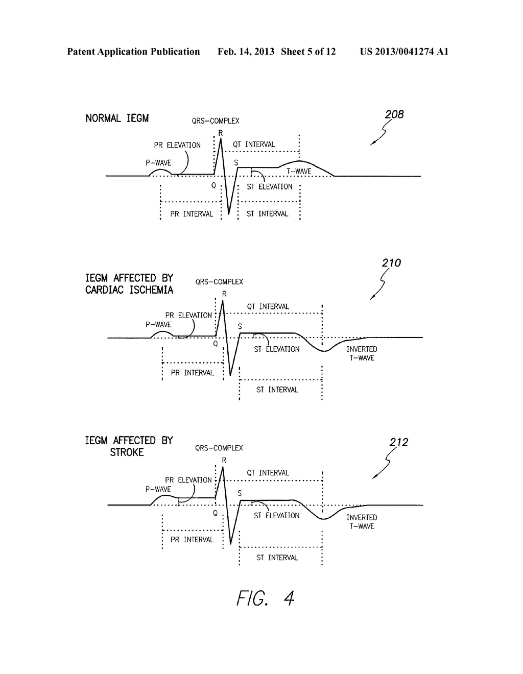 SYSTEMS AND METHODS FOR USE BY IMPLANTABLE MEDICAL DEVICES FOR DETECTING     AND DISCRIMINATING STROKE AND CARDIAC ISCHEMIA USING ELECTROCARDIAC     SIGNALS - diagram, schematic, and image 06