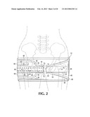 DEVICE AND METHOD FOR CONTROL OF HEMORRHAGE diagram and image