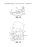 DEVICE AND METHOD FOR CONTROL OF HEMORRHAGE diagram and image