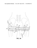 DEVICE AND METHOD FOR CONTROL OF HEMORRHAGE diagram and image