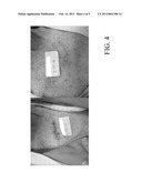 Laser Assisted Nail Avulsion diagram and image