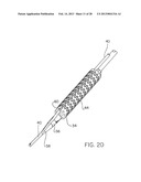 CATHETER WITH DISRUPTABLE GUIDEWIRE CHANNEL diagram and image