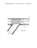 CATHETER WITH DISRUPTABLE GUIDEWIRE CHANNEL diagram and image