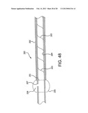 CATHETER WITH DISRUPTABLE GUIDEWIRE CHANNEL diagram and image