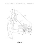 Modular Drug Delivery System for Minimizing Trauma During and After     Insertion of a Cochlear Lead diagram and image