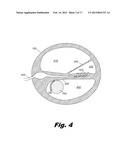 Modular Drug Delivery System for Minimizing Trauma During and After     Insertion of a Cochlear Lead diagram and image