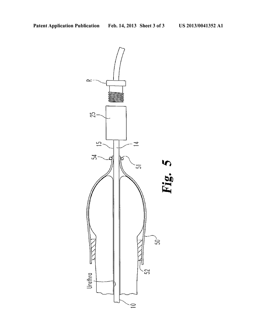 Self-Cleansing Bladder Drainage Catheter - diagram, schematic, and image 04