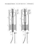 EMBOLIC PROTECTION SYSTEM diagram and image