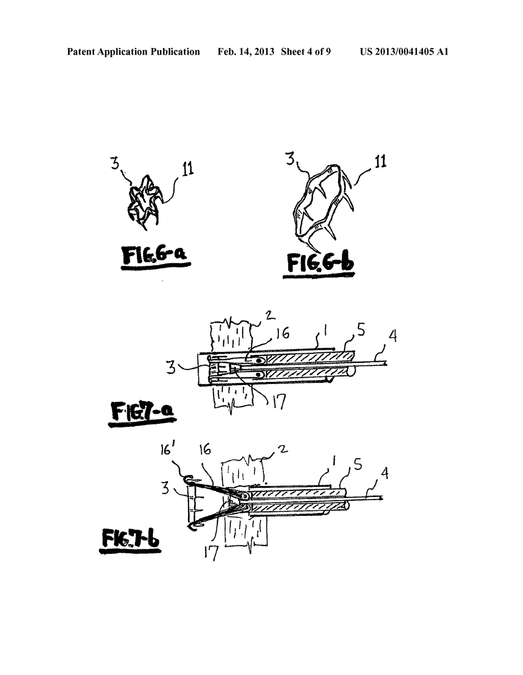 METHOD AND DEVICE FOR CLOSING HOLES IN TISSUE - diagram, schematic, and image 05