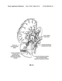 DUODENAL STIMULATION TO INDUCE SATIETY diagram and image