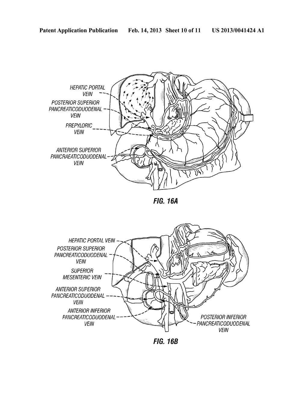 DUODENAL STIMULATION TO INDUCE SATIETY - diagram, schematic, and image 11