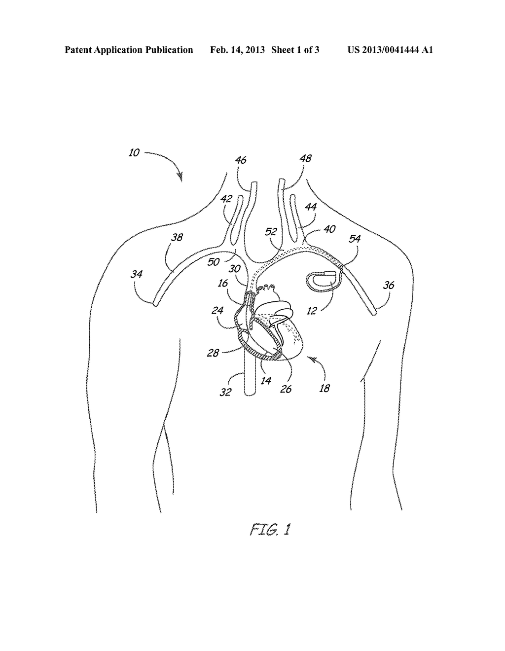 MEDICAL DEVICE LEAD WITH CONDUCTOR FRACTURE PREDICTION - diagram, schematic, and image 02