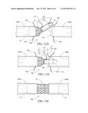 PROSTHESIS DEPLOYMENT SYSTEM FOR OPEN SURGICAL REPAIR diagram and image