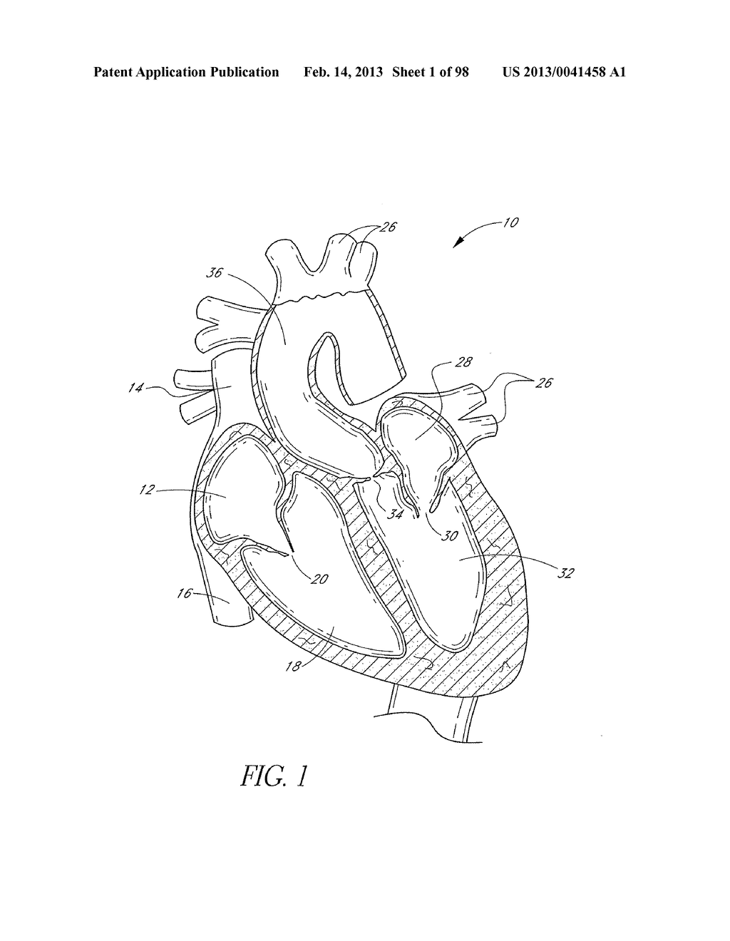 METHOD OF IN SITU FORMATION OF TRANSLUMENALLY DEPLOYABLE HEART VALVE     SUPPORT - diagram, schematic, and image 02