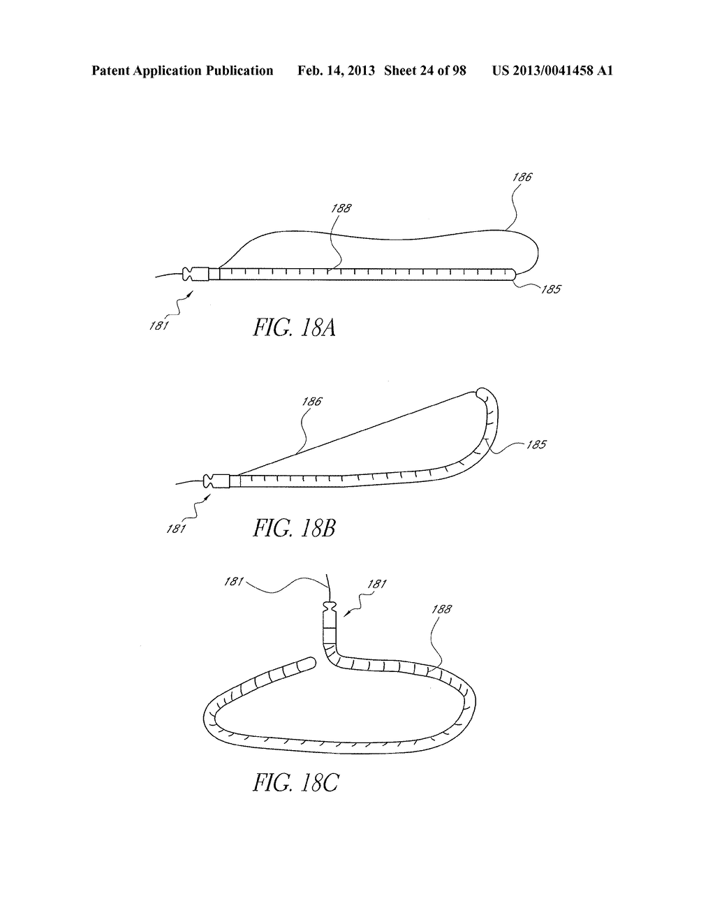 METHOD OF IN SITU FORMATION OF TRANSLUMENALLY DEPLOYABLE HEART VALVE     SUPPORT - diagram, schematic, and image 25