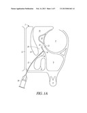 METHOD AND APPARATUS FOR TREATING DILATING THE ETHMOID INFUNDIBULUM diagram and image