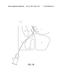 METHOD AND APPARATUS FOR TREATING DILATING THE ETHMOID INFUNDIBULUM diagram and image