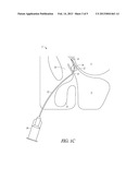 METHOD AND APPARATUS FOR TREATING DILATING THE ETHMOID INFUNDIBULUM diagram and image