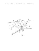 POSITIONING SYSTEMS AND METHODS FOR IMPLANTING AN ENERGY ABSORBING SYSTEM diagram and image