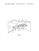 POSITIONING SYSTEMS AND METHODS FOR IMPLANTING AN ENERGY ABSORBING SYSTEM diagram and image