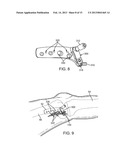 POSITIONING SYSTEMS AND METHODS FOR IMPLANTING AN ENERGY ABSORBING SYSTEM diagram and image