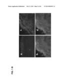 PLA2ACTIVITY AS A MARKER FOR OVARIAN AND OTHER GYNECOLOGIC CANCERS diagram and image