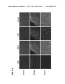 PLA2ACTIVITY AS A MARKER FOR OVARIAN AND OTHER GYNECOLOGIC CANCERS diagram and image