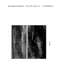 METHOD AND SYSTEM OF CHARACTERIZATION OF CAROTID PLAQUE diagram and image