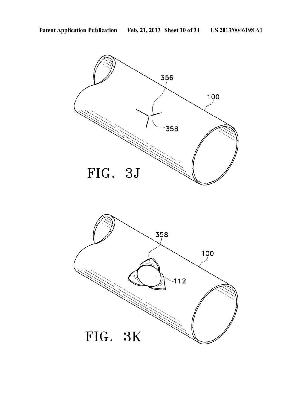 METHODS FOR MAINTAINING THE PATENCY OF COLLATERAL CHANNELS IN THE LUNGS     USING CRYO-ENERGY - diagram, schematic, and image 11