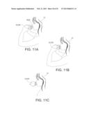 LIP ENHANCEMENT AND ENLARGEMENT DEVICE diagram and image