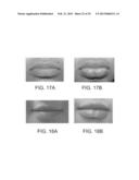 LIP ENHANCEMENT AND ENLARGEMENT DEVICE diagram and image