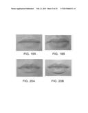 LIP ENHANCEMENT AND ENLARGEMENT DEVICE diagram and image