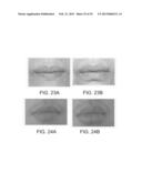 LIP ENHANCEMENT AND ENLARGEMENT DEVICE diagram and image