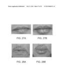 LIP ENHANCEMENT AND ENLARGEMENT DEVICE diagram and image