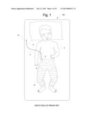 SYSTEMS AND METHODS FOR PROVIDING A CHANNEL THROUGH AN ORTHOPEDIC CAST diagram and image