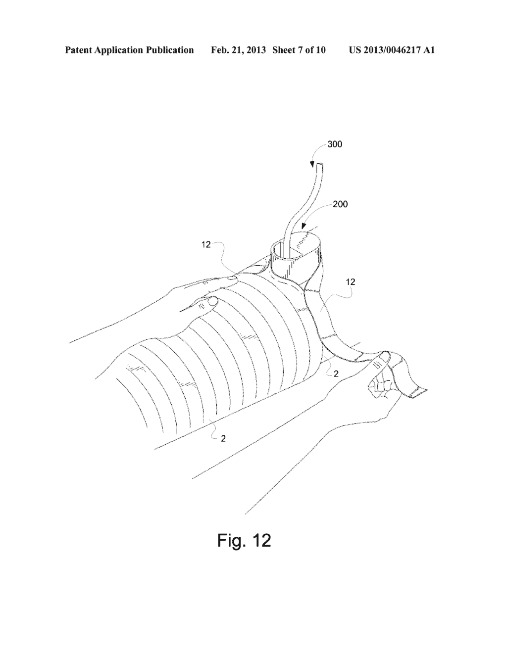 SYSTEMS AND METHODS FOR PROVIDING A CHANNEL THROUGH AN ORTHOPEDIC CAST - diagram, schematic, and image 08