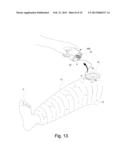 SYSTEMS AND METHODS FOR PROVIDING A CHANNEL THROUGH AN ORTHOPEDIC CAST diagram and image