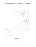 SYSTEMS AND METHODS FOR PROVIDING A CHANNEL THROUGH AN ORTHOPEDIC CAST diagram and image