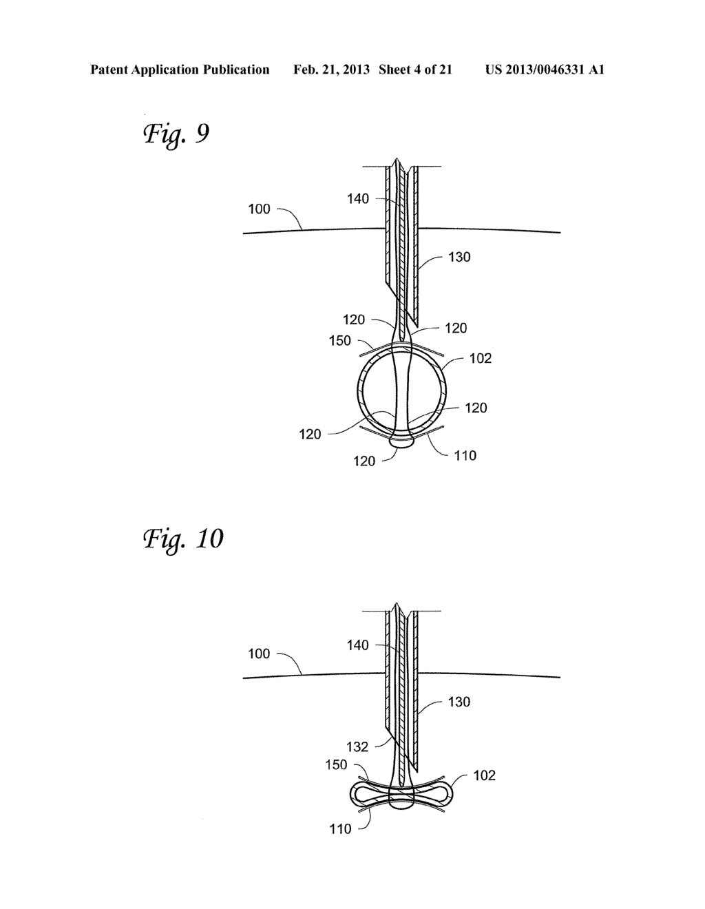 BODY LUMEN OCCLUSION APPARATUS AND METHODS - diagram, schematic, and image 05