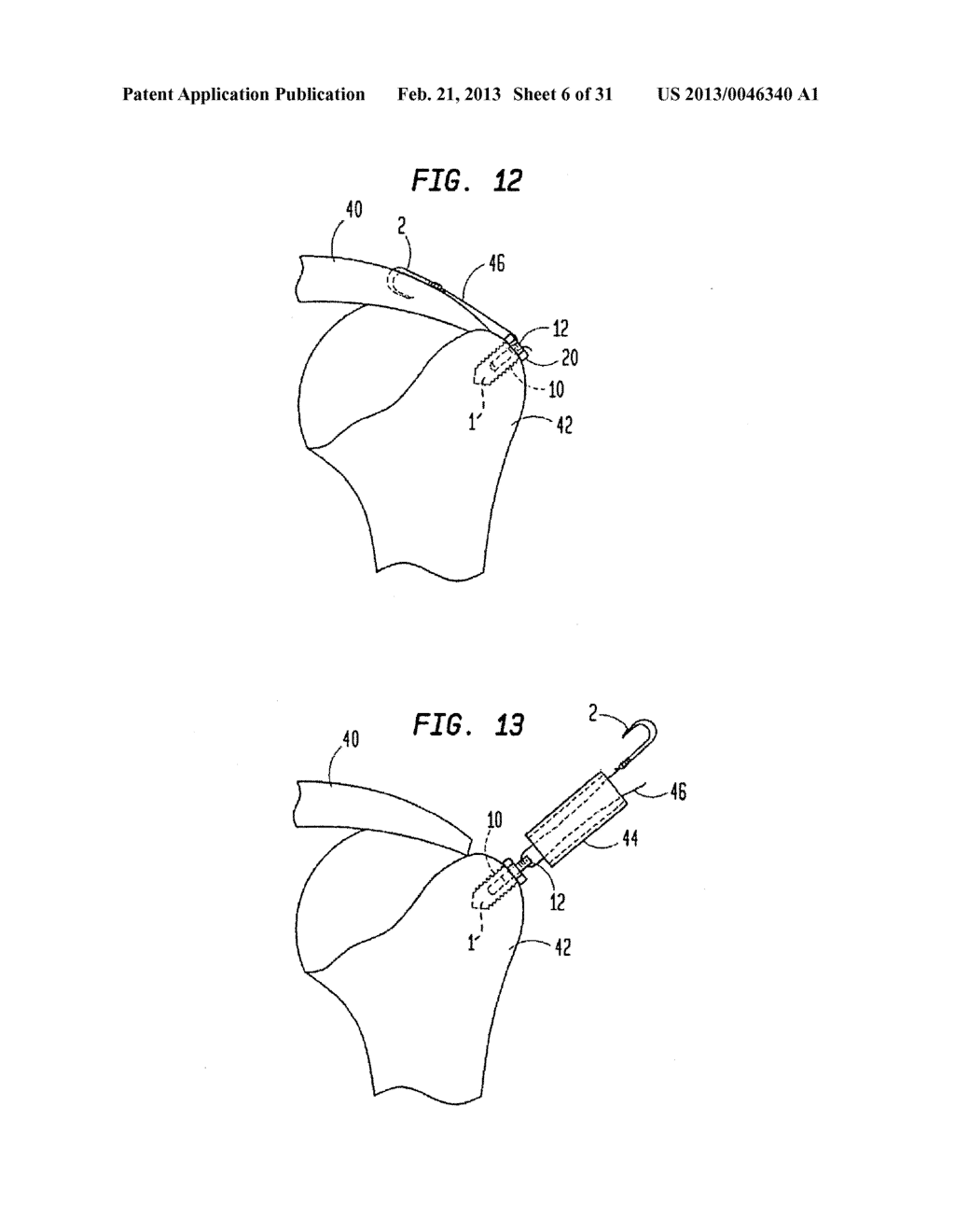 MEDICAL DEVICE AND PROCEDURE FOR ATTACHING TISSUE TO BONE - diagram, schematic, and image 07