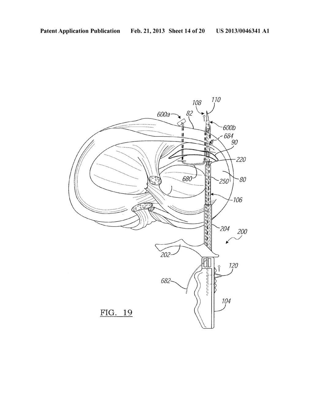 Soft Tissue Repair Device And Associated Methods - diagram, schematic, and image 15